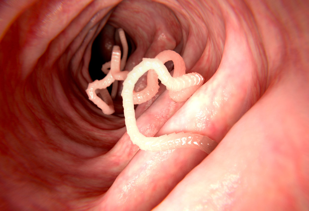 pinworms súlyos fertőzés